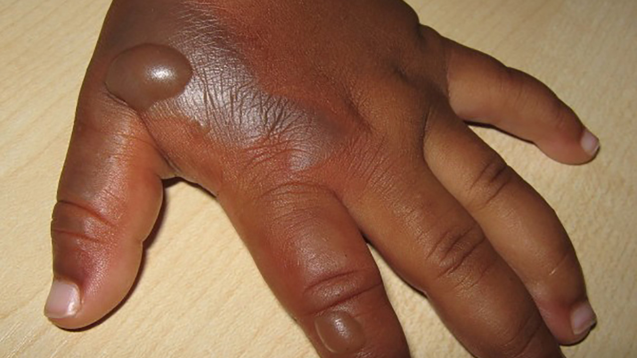 Stepmum Scalds 9 year old Boy With Cooking Oil For stealing Maize